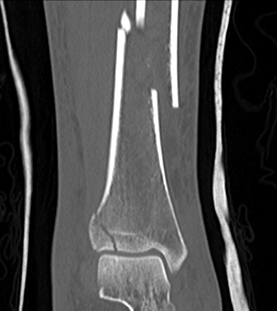 Distal tibia CT